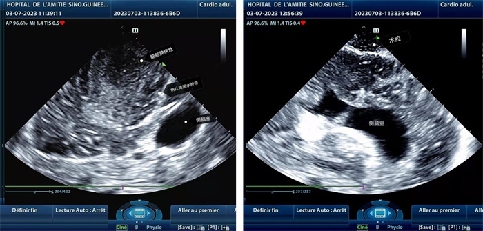 左圖顯示術(shù)中超聲見囊實性病變，大小約為4x4x3cm，病灶周圍腦組織水腫明顯；右圖為病灶切除后，術(shù)中超聲示術(shù)腔無病變殘留