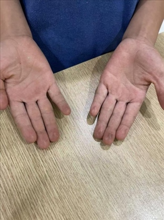 9歲小學生長期拍煙卡，手部粗糙長繭。受訪者供圖